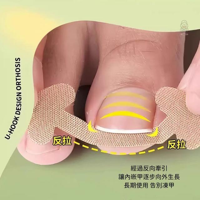 預購 內嵌指甲矯正貼 一組240貼 -11/26號中午12點結單